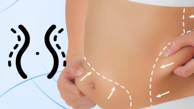 Liposuction - Esthé Nuance